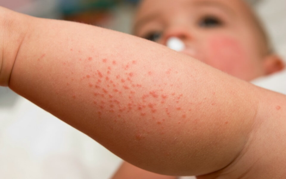 14 newborn rashes you need to know about