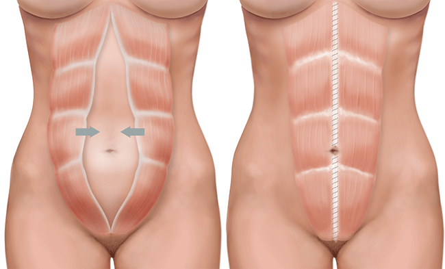 muscle-separation